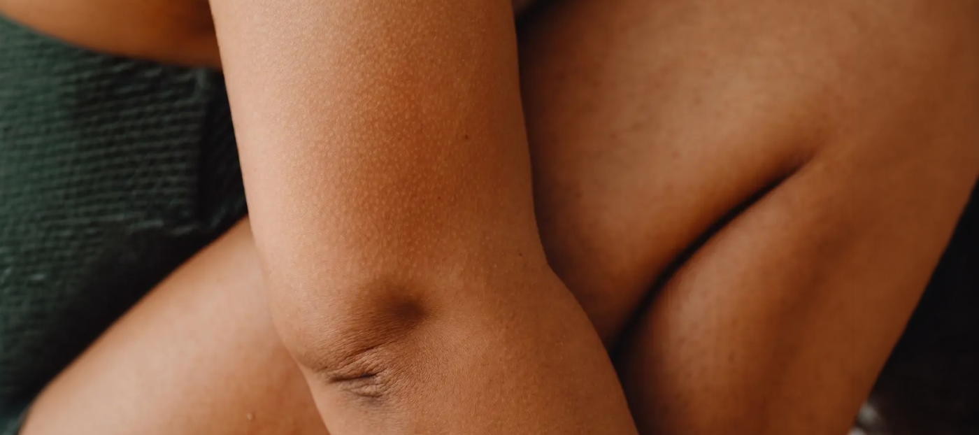 Lipödem oder Cellulite?